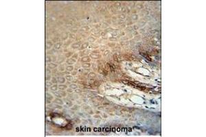 ITA6 Monoclonal Antibody (ABIN658988 and ABIN2838034) immunohistochemistry analysis in formalin fixed and paraffin embedded human skin carcinoma followed by peroxidase conjμgation of the secondary antibody and DAB staining. (ITGA6 Antikörper)