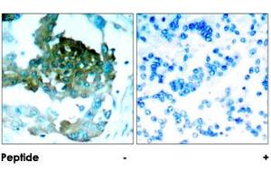 Immunohistochemical analysis of paraffin-embedded human lung carcinoma tissue using PRKCQ polyclonal antibody . (PKC theta Antikörper)