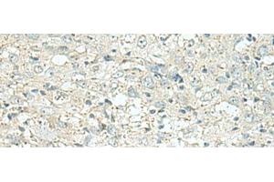 Immunohistochemistry of paraffin-embedded Human esophagus cancer tissue using DENND6A Polyclonal Antibody at dilution of 1:120(x200) (FAM116A Antikörper)