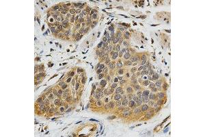 Immunohistochemistry of paraffin-embedded human esophageal cancer using ABO antibody at dilution of 1:200 (x400 lens). (ABO Antikörper)