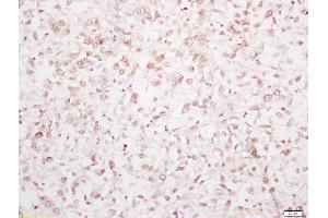 Formalin-fixed and paraffin embedded human breast carcinoma labeled with Rabbit Anti-YAP1 Polyclonal Antibody, Unconjugated 1:200 followed by conjugation to the secondary antibody and DAB staining