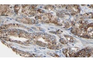 ABIN6279709 at 1/100 staining Human prostate tissue by IHC-P. (RABL5 Antikörper  (Internal Region))