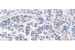 Immunohistochemistry of paraffin-embedded Human breast cancer tissue using LAMP3 Polyclonal Antibody at dilution of 1:30(x200) (LAMP3 Antikörper)