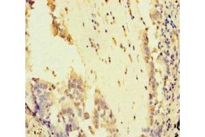 Immunohistochemistry of paraffin-embedded human lung cancer using ABIN7169011 at dilution of 1:100 (ATR Antikörper  (AA 2405-2644))