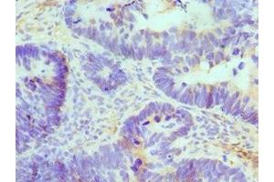 Immunohistochemistry of paraffin-embedded human ovarian cancer using ABIN7145049 at dilution of 1:100 (ATRIP Antikörper  (AA 1-260))