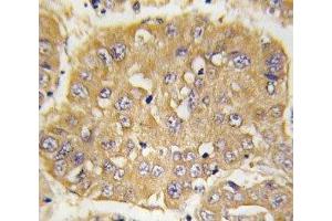 IHC analysis of FFPE human hepatocarcinoma tissue stained with IGFBP3 antibody (IGFBP3 Antikörper  (AA 163-193))