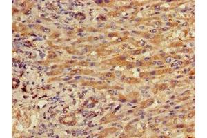 Immunohistochemistry of paraffin-embedded human liver cancer using ABIN7156490 at dilution of 1:100 (Integrin beta 5 Antikörper  (AA 431-637))