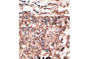 Formalin-fixed and paraffin-embedded human cancer tissue reacted with the primary antibody, which was peroxidase-conjugated to the secondary antibody, followed by AEC staining. (PDGFD Antikörper  (AA 313-341))