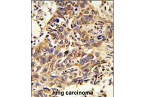 Formalin-fixed and paraffin-embedded human lung carcinoma reacted with CAT Antibody , which was peroxidase-conjugated to the secondary antibody, followed by DAB staining. (Catalase Antikörper  (AA 152-180))