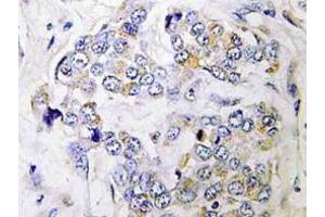 Immunohistochemistry (IHC) analyzes of PRIM1 antibody in paraffin-embedded human breast carcinoma tissue. (PRIM1 Antikörper)