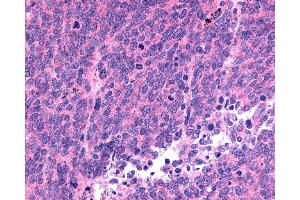 Anti-SSTR1 antibody IHC of human Lung, Small Cell Carcinoma.