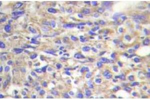Immunohistochemistry (IHC) analyzes of Laminin beta-1 antibody in paraffin-embedded human liver carcinoma tissue. (Laminin beta 1 Antikörper)