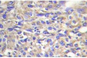 Immunohistochemistry (IHC) analyzes of Laminin beta-1 antibody in paraffin-embedded human liver carcinoma tissue.
