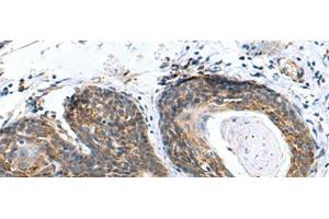 Immunohistochemistry of paraffin-embedded Human esophagus cancer tissue using AP1S3 Polyclonal Antibody at dilution of 1:70(x200) (AP1S3 Antikörper)