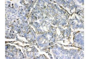 IHC testing of FFPE human lung cancer tissue with HBD antibody at 1ug/ml.