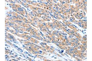 The image on the left is immunohistochemistry of paraffin-embedded Human esophagus cancer tissue using ABIN7128229(ADAM2 Antibody) at dilution 1/20, on the right is treated with fusion protein. (ADAM2 Antikörper)