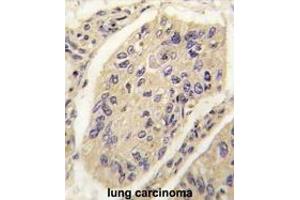 Formalin-fixed and paraffin-embedded human lung carcinoma tissue reacted with GHRH antibody (N-term) (ABIN392174 and ABIN2841887) , which was peroxidase-conjugated to the secondary antibody, followed by DAB staining. (GHRH Antikörper  (N-Term))