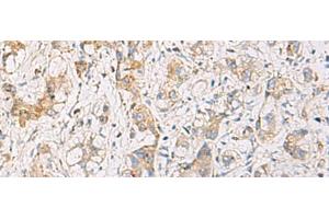 Immunohistochemistry of paraffin-embedded Human liver cancer tissue using FYCO1 Polyclonal Antibody at dilution of 1:110(x200) (FYCO1 Antikörper)