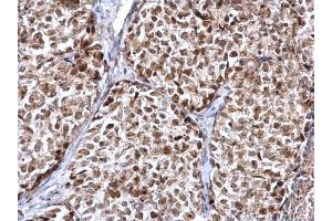 IHC-P Image FEN1 antibody detects FEN1 protein at nucleus on human breast carcinoma by immunohistochemical analysis. (FEN1 Antikörper)