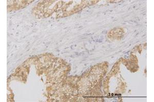 Immunoperoxidase of monoclonal antibody to RIPK2 on formalin-fixed paraffin-embedded human prostate. (RIPK2 Antikörper  (AA 431-540))