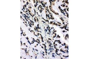 Anti-SNRPN antibody, IHC(P) IHC(P): Human Intestinal Cancer Tissue (SNRPN Antikörper  (N-Term))