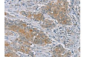 The image on the left is immunohistochemistry of paraffin-embedded Human ovarian cancer tissue using ABIN7192147(RASA2 Antibody) at dilution 1/45, on the right is treated with synthetic peptide.