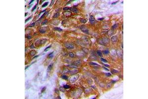 Immunohistochemical analysis of PAK1 (pT212) staining in human prostate cancer formalin fixed paraffin embedded tissue section. (PAK1 Antikörper  (pSer212))