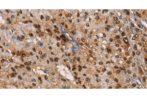 Immunohistochemistry of paraffin-embedded Human liver cancer tissue using TSPEAR Polyclonal Antibody at dilution 1:50 (TSPEAR Antikörper)