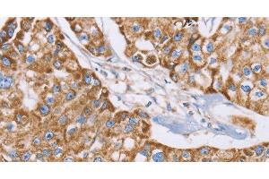 Immunohistochemistry of paraffin-embedded Human breast cancer tissue using GUCY1A3 Polyclonal Antibody at dilution 1:40 (GUCY1A1 Antikörper)