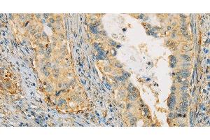 Immunohistochemistry of paraffin-embedded Human cervical cancer tissue using APOA4 Polyclonal Antibody at dilution 1:30 (APOA4 Antikörper)