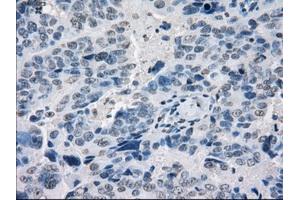 Immunohistochemical staining of paraffin-embedded Adenocarcinoma of breast tissue using anti-POR mouse monoclonal antibody. (POR Antikörper)