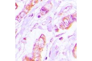 Immunohistochemical analysis of Tropomyosin 2 staining in human lung cancer formalin fixed paraffin embedded tissue section. (TPM2 Antikörper)