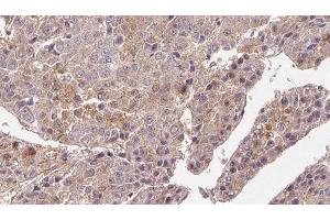 ABIN6276687 at 1/100 staining Human liver cancer tissue by IHC-P. (FSHR Antikörper  (Internal Region))