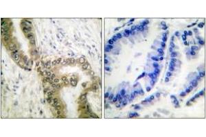 Immunohistochemistry analysis of paraffin-embedded human lung carcinoma tissue, using p53 (Acetyl-Lys386) Antibody. (p53 Antikörper  (acLys386))