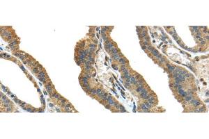 Immunohistochemistry of paraffin-embedded Human thyroid cancer tissue using TMPRSS13 Polyclonal Antibody at dilution 1:40 (TMPRSS13 Antikörper)