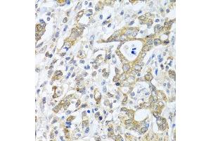 Immunohistochemistry of paraffin-embedded human gastric cancer using TICAM1 antibody at dilution of 1:100 (40x lens). (TICAM1 Antikörper)