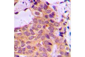 Immunohistochemical analysis of PKC zeta staining in human breast cancer formalin fixed paraffin embedded tissue section. (PKC zeta Antikörper  (C-Term))