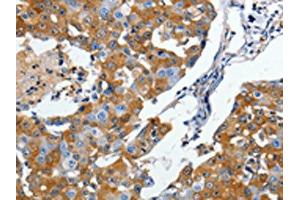 The image on the left is immunohistochemistry of paraffin-embedded Human breast cancer tissue using ABIN7190498(DPYSL5 Antibody) at dilution 1/10, on the right is treated with synthetic peptide. (DPYSL5 Antikörper)