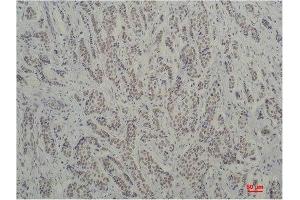 Immunohistochemistry (IHC) analysis of paraffin-embedded Human Breast Carcinoma using TBP/TATA Binding Protein Mouse Monoclonal Antibody diluted at 1:200. (TBP Antikörper)
