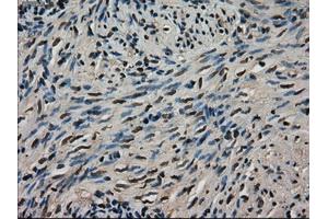 Immunohistochemical staining of paraffin-embedded Adenocarcinoma of colon tissue using anti-LDHAmouse monoclonal antibody. (Lactate Dehydrogenase A Antikörper)