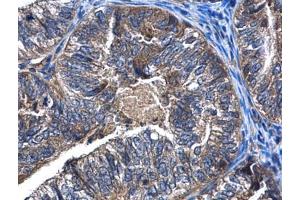 IHC-P Image CaMKK beta antibody detects CaMKK beta protein at cytoplasm in human endometrial cancer by immunohistochemical analysis. (CAMKK2 Antikörper  (N-Term))