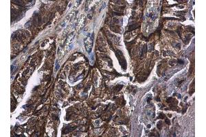 IHC-P Image CD89 antibody detects CD89 protein at cytoplasm in human cervical carcinoma by immunohistochemical analysis.