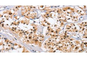 Immunohistochemistry of paraffin-embedded Human thyroid cancer tissue using NCAPD3 Polyclonal Antibody at dilution 1:50 (NCAPD3 Antikörper)