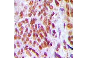 Immunohistochemical analysis of HMGB2 staining in human breast cancer formalin fixed paraffin embedded tissue section. (HMGB2 Antikörper)