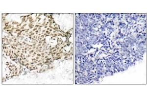Immunohistochemical analysis of paraffin-embedded human breast carcinoma tissue using p95/NBS1 (Ab-343) antibody (E021058). (Nibrin Antikörper)