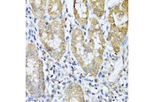 Immunohistochemistry of paraffin-embedded human gastric cancer using ASIP antibody (ABIN5974140) at dilution of 1/100 (40x lens). (ASIP Antikörper)