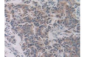 IHC-P analysis of Human Prostate Gland Cancer Tissue, with DAB staining. (SLC12A3 Antikörper  (AA 867-1024))