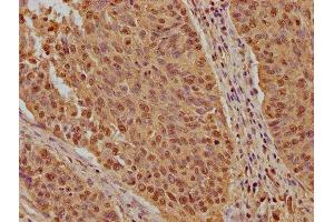 IHC image of ABIN7156134 diluted at 1:200 and staining in paraffin-embedded human cervical cancer performed on a Leica BondTM system. (KPNB1 Antikörper  (AA 9-214))