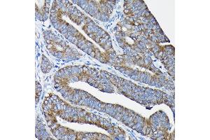 Immunohistochemistry of paraffin-embedded human colon carcinoma using Nesprin 1 Rabbit pAb (ABIN7270520) at dilution of 1:100 (40x lens). (SYNE1 Antikörper)