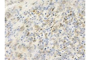 ABIN6259327 and ABIN6275300 at 1/100 staining human melanoma by IHC-P. (NBPF5 Antikörper)